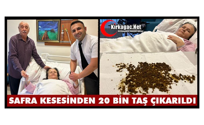 SAFRA KESESİNDEN 20 BİNİN ÜZERİNDE TAŞ ÇIKARILDI